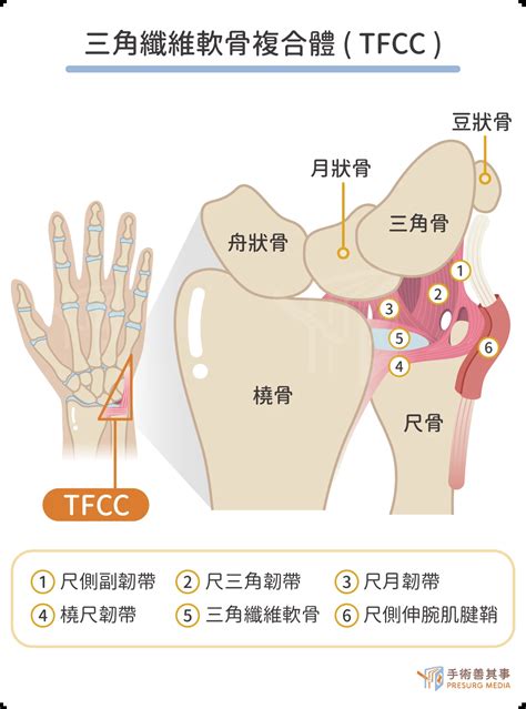 手受傷|手腕的黑盒子 ── 三角纖維軟骨複合體（TFCC）損傷